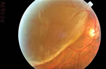 Retina Detachment